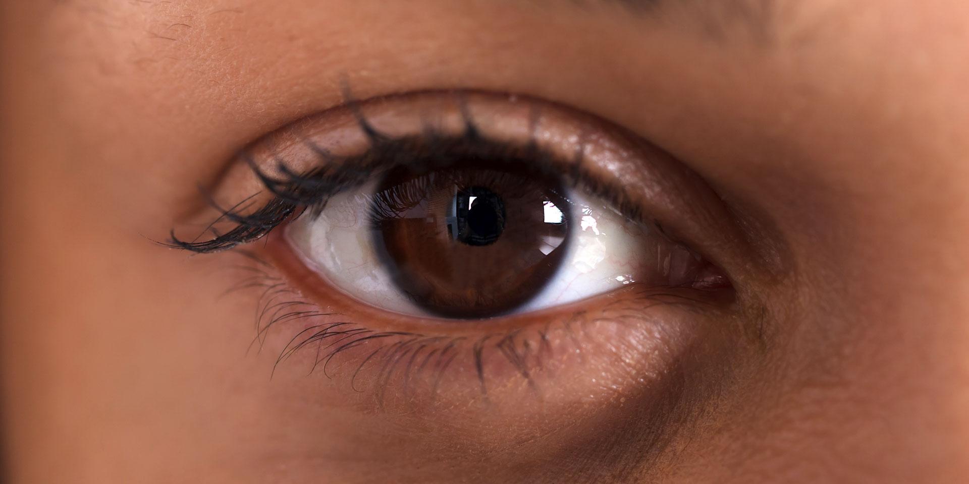 Dark circles under eyes