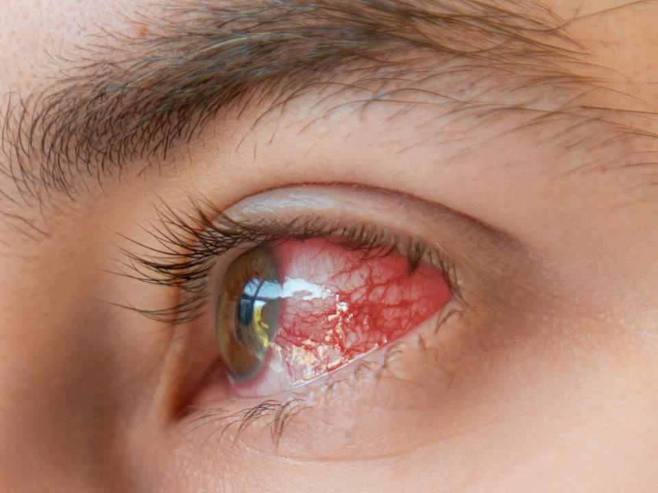 Image showing photokeratitis.